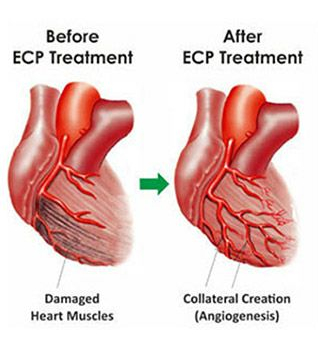 Tyagi-ECP-treatment